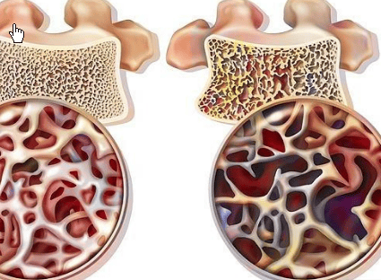 强烈建议骨质疏松的人多运动力量训练和平衡训练的多模式训练方案。原因很简单：骨骼、肌肉、姿势控制和跌倒风险并非孤立存在，而是密切相关。