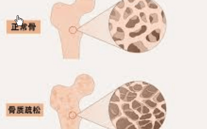 强烈建议骨质疏松的人多运动力量训练和平衡训练的多模式训练方案。原因很简单：骨骼、肌肉、姿势控制和跌倒风险并非孤立存在，而是密切相关。